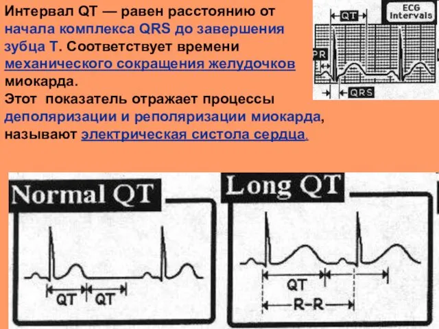 Интервал QT — равен расстоянию от начала комплекса QRS до