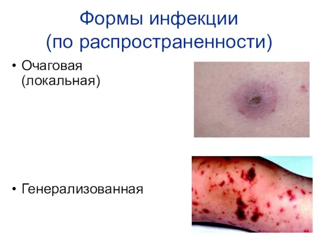 Формы инфекции (по распространенности) Очаговая (локальная) Генерализованная