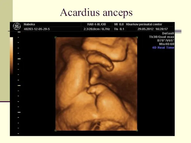 Acardius anceps