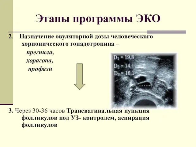 2. Назначение овуляторной дозы человеческого хорионического гонадотропина – прегнила, хорагона,