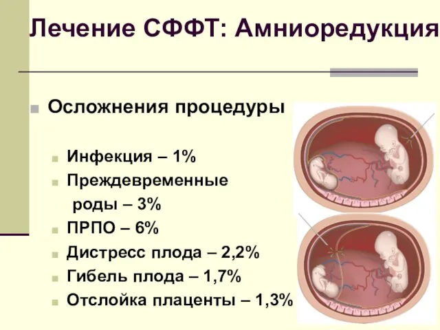 Лечение СФФТ: Амниоредукция Осложнения процедуры Инфекция – 1% Преждевременные роды