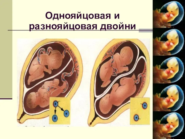 Однояйцовая и разнояйцовая двойни