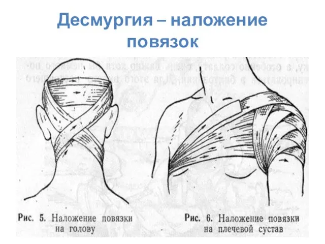 Десмургия – наложение повязок