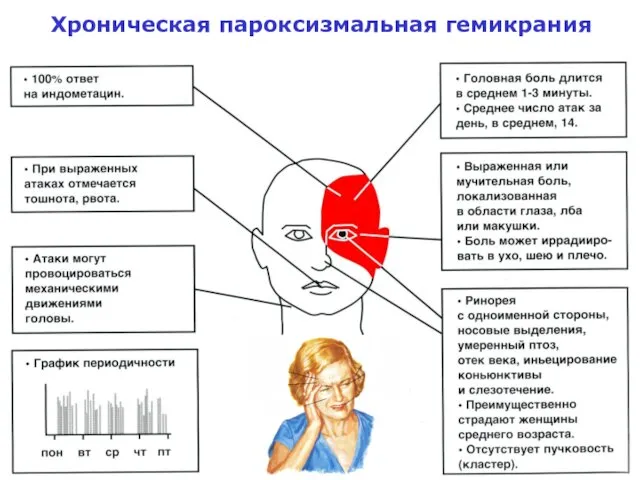 Хроническая пароксизмальная гемикрания