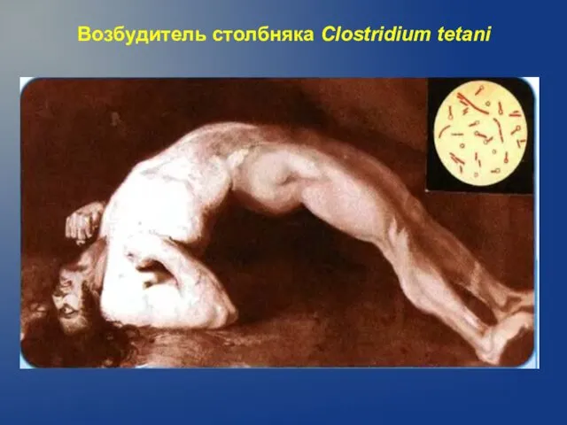 Возбудитель столбняка Clostridium tetani