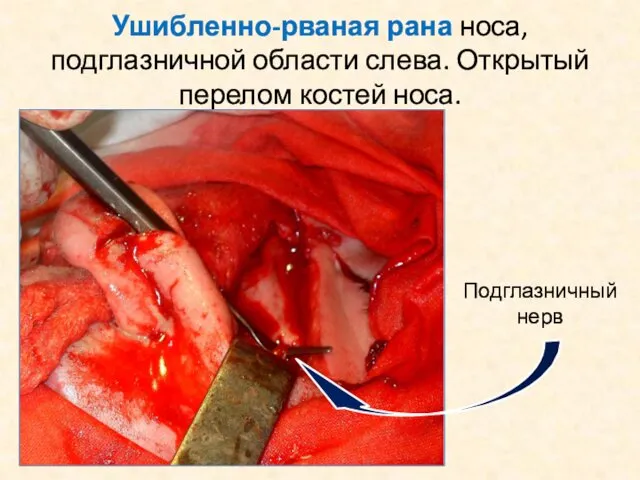 Ушибленно-рваная рана носа, подглазничной области слева. Открытый перелом костей носа. Подглазничный нерв