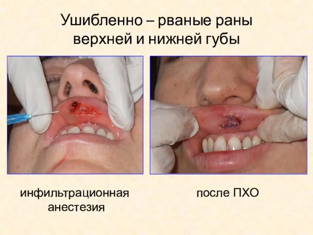 Ушибленно – рваные раны верхней и нижней губы инфильтрационная анестезия после ПХО