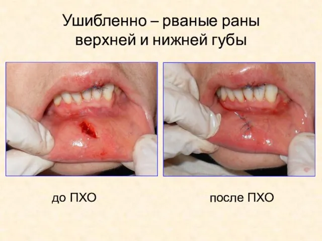 Ушибленно – рваные раны верхней и нижней губы после ПХО до ПХО