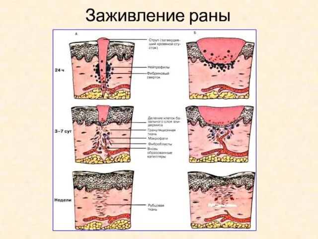 Заживление раны