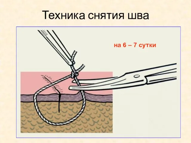 Техника снятия шва на 6 – 7 сутки