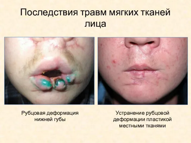 Последствия травм мягких тканей лица Рубцовая деформация нижней губы Устранение рубцовой деформации пластикой местными тканями