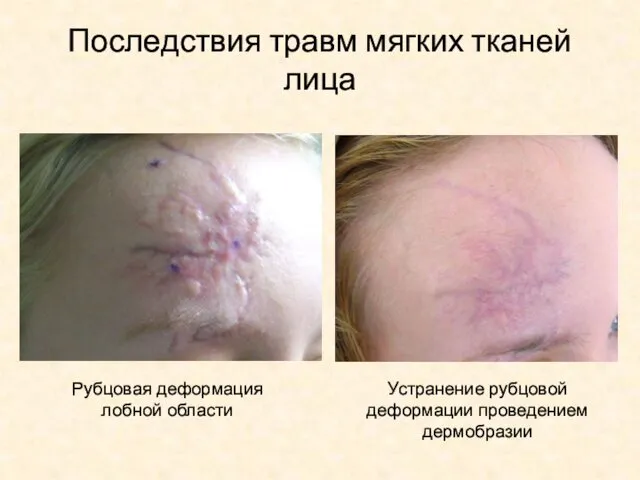Последствия травм мягких тканей лица Рубцовая деформация лобной области Устранение рубцовой деформации проведением дермобразии