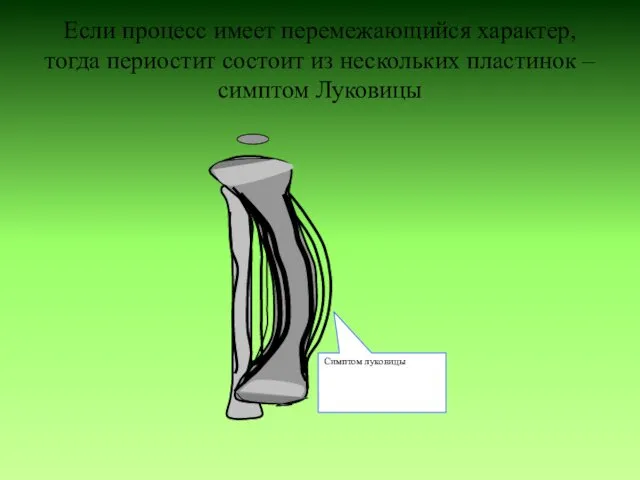 Если процесс имеет перемежающийся характер, тогда периостит состоит из нескольких пластинок – симптом Луковицы