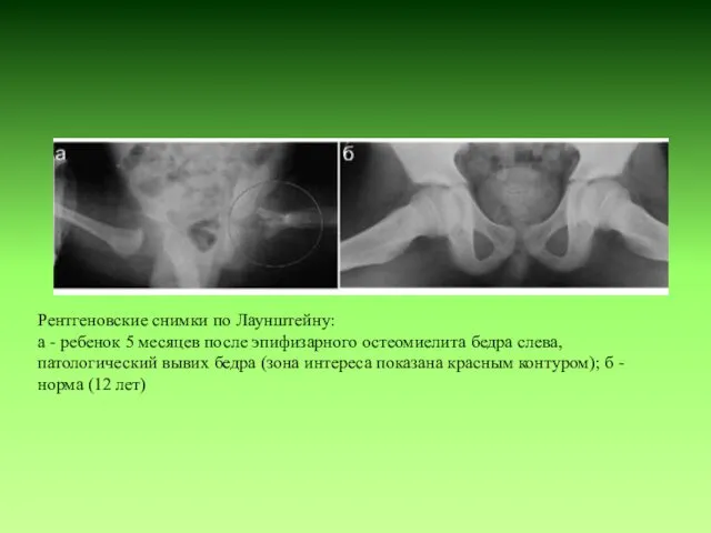 Рентгеновские снимки по Лаунштейну: а - ребенок 5 месяцев после