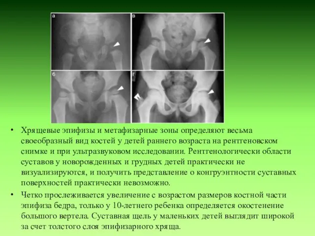 Хрящевые эпифизы и метафизарные зоны определяют весьма своеобразный вид костей