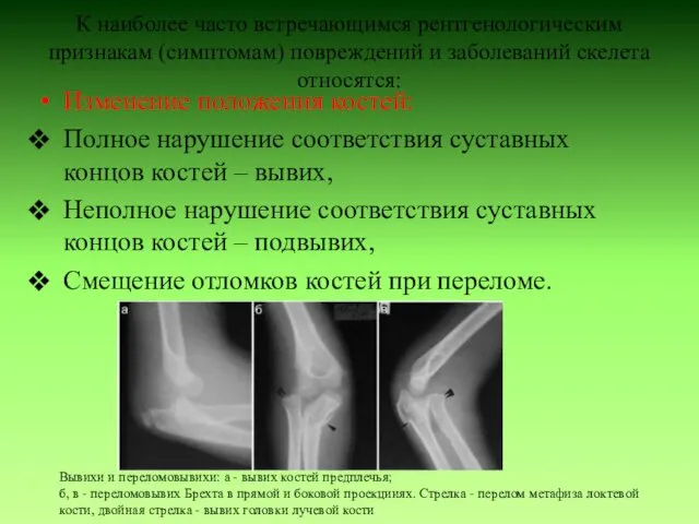 К наиболее часто встречающимся рентгенологическим признакам (симптомам) повреждений и заболеваний