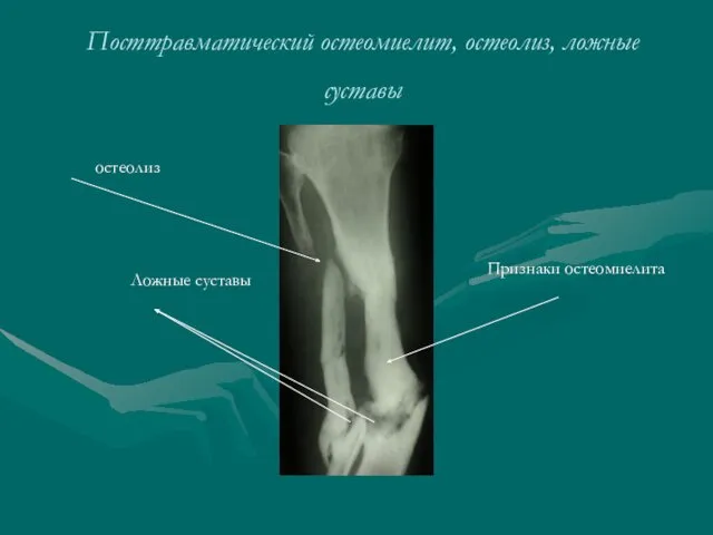 Посттравматический остеомиелит, остеолиз, ложные суставы Признаки остеомиелита остеолиз Ложные суставы