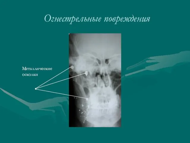 Огнестрельные повреждения Металлические осколки