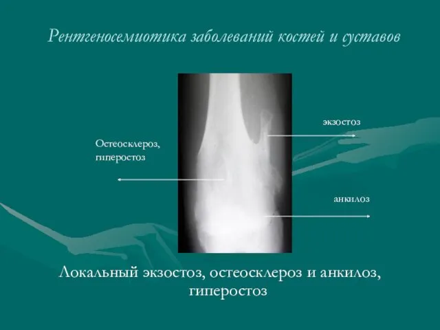 Рентгеносемиотика заболеваний костей и суставов Локальный экзостоз, остеосклероз и анкилоз, гиперостоз экзостоз Остеосклероз, гиперостоз анкилоз