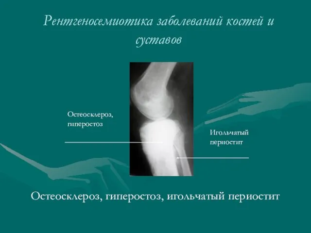 Рентгеносемиотика заболеваний костей и суставов Остеосклероз, гиперостоз, игольчатый периостит Остеосклероз, гиперостоз Игольчатый периостит