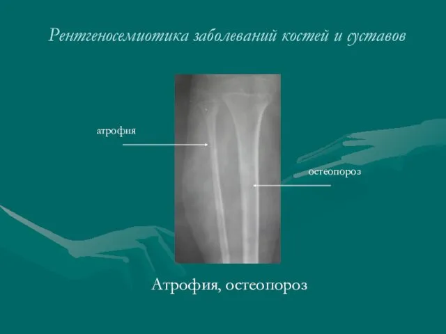 Рентгеносемиотика заболеваний костей и суставов Атрофия, остеопороз атрофия остеопороз