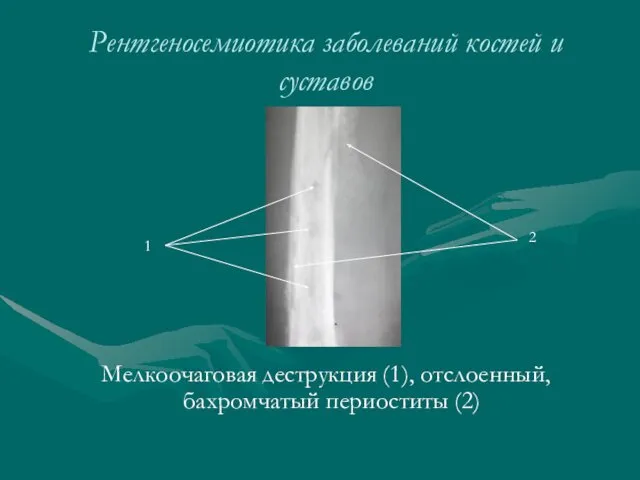 Рентгеносемиотика заболеваний костей и суставов Мелкоочаговая деструкция (1), отслоенный, бахромчатый периоститы (2) 1 2