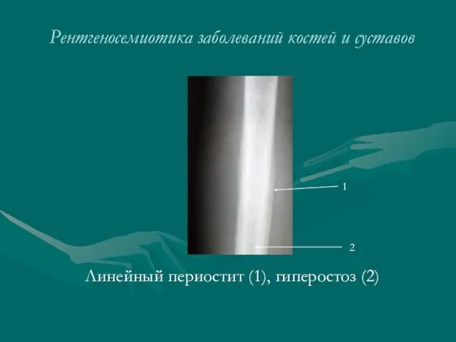 Рентгеносемиотика заболеваний костей и суставов Линейный периостит (1), гиперостоз (2) 1 2