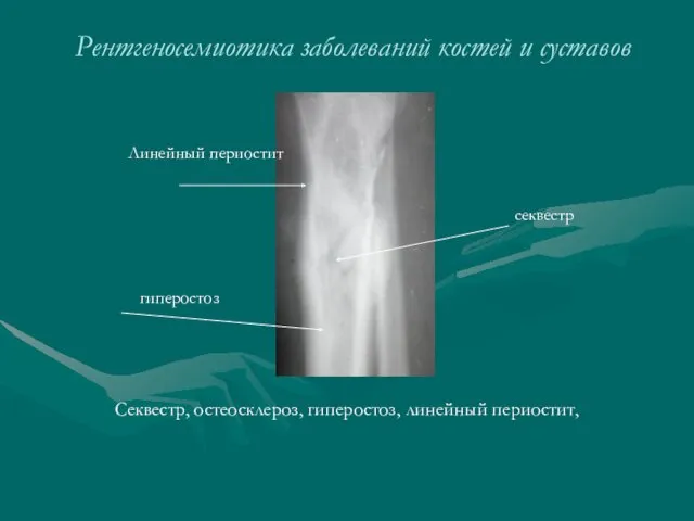 Рентгеносемиотика заболеваний костей и суставов Секвестр, остеосклероз, гиперостоз, линейный периостит, секвестр гиперостоз Линейный периостит