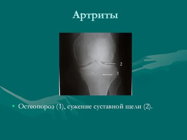 Артриты Остеопороз (1), сужение суставной щели (2). 2 1