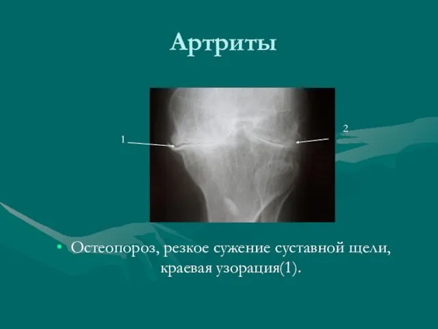 Артриты Остеопороз, резкое сужение суставной щели, краевая узорация(1). 1 2