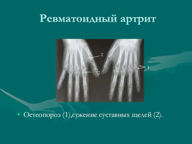 Ревматоидный артрит Остеопороз (1),сужение суставных щелей (2). 1 2 2 2