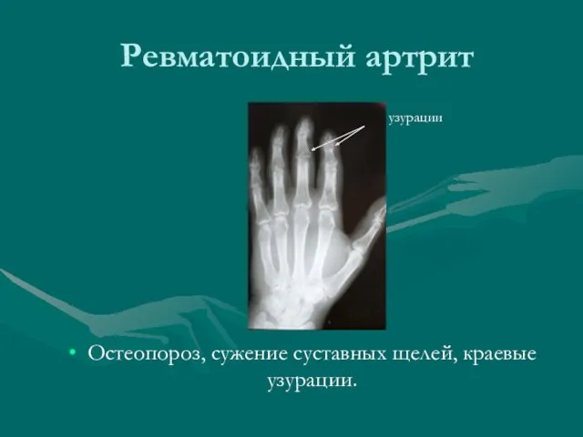 Ревматоидный артрит Остеопороз, сужение суставных щелей, краевые узурации. узурации