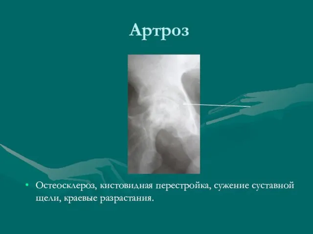 Артроз Остеосклероз, кистовидная перестройка, сужение суставной щели, краевые разрастания.