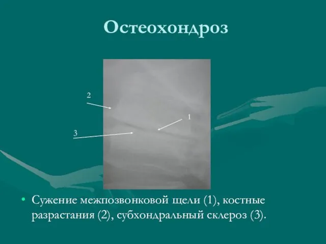 Остеохондроз Сужение межпозвонковой щели (1), костные разрастания (2), субхондральный склероз (3). 1 2 3