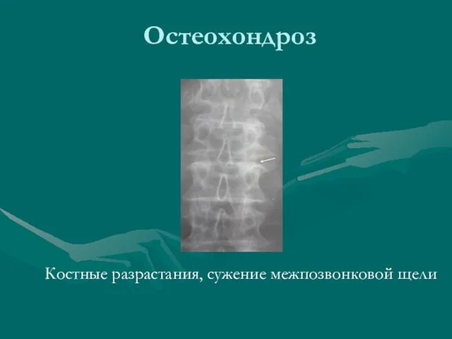 Остеохондроз Костные разрастания, сужение межпозвонковой щели