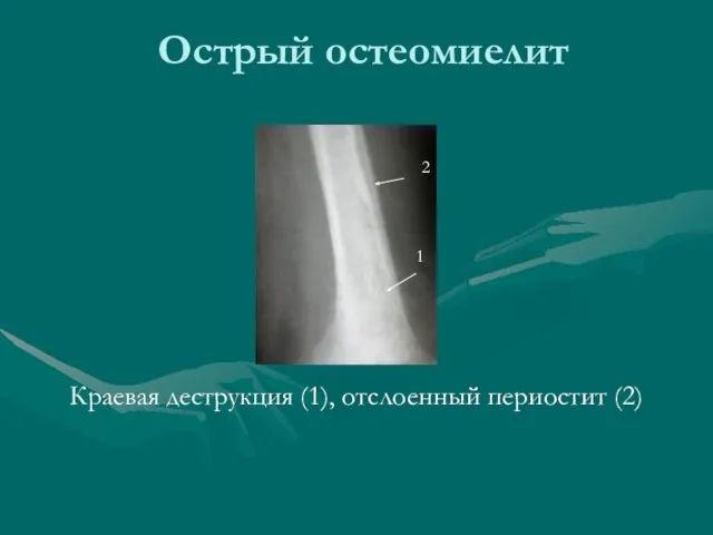 Острый остеомиелит Краевая деструкция (1), отслоенный периостит (2) 2 1