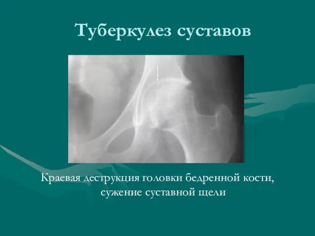 Туберкулез суставов Краевая деструкция головки бедренной кости, сужение суставной щели