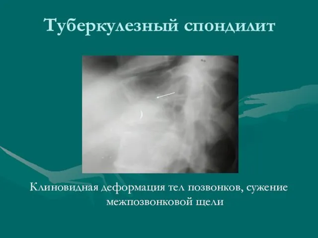 Туберкулезный спондилит Клиновидная деформация тел позвонков, сужение межпозвонковой щели