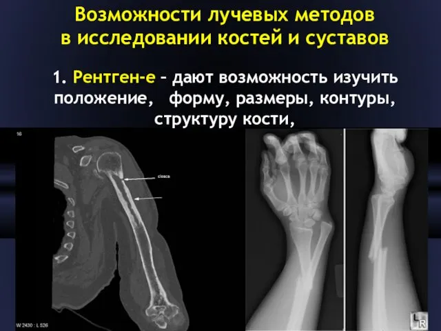 Возможности лучевых методов в исследовании костей и суставов 1. Рентген-е – дают возможность