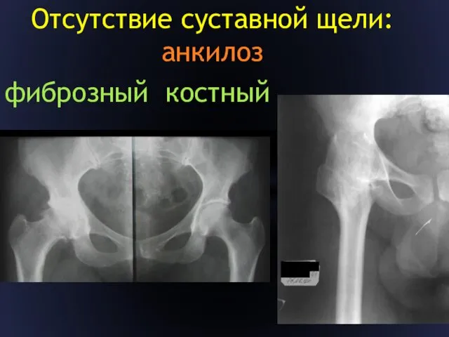 Отсутствие суставной щели: анкилоз фиброзный костный
