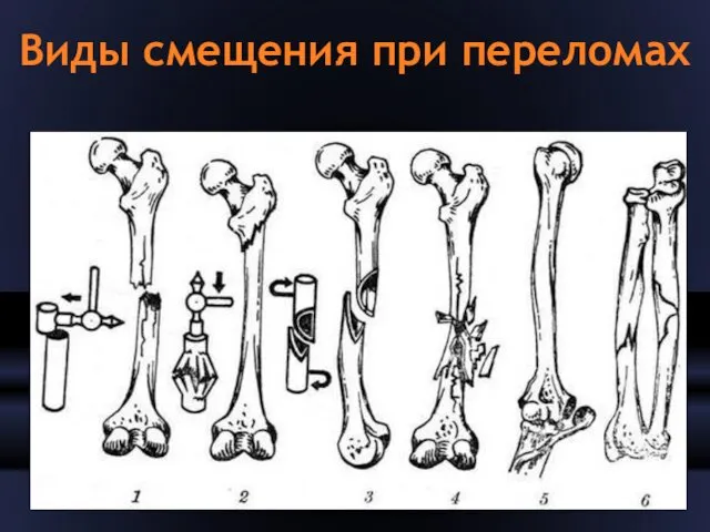 Виды смещения при переломах