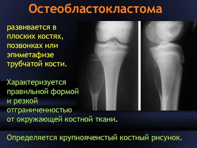 Остеобластокластома развивается в плоских костях, позвонках или эпиметафизе трубчатой кости. Характеризуется правильной формой