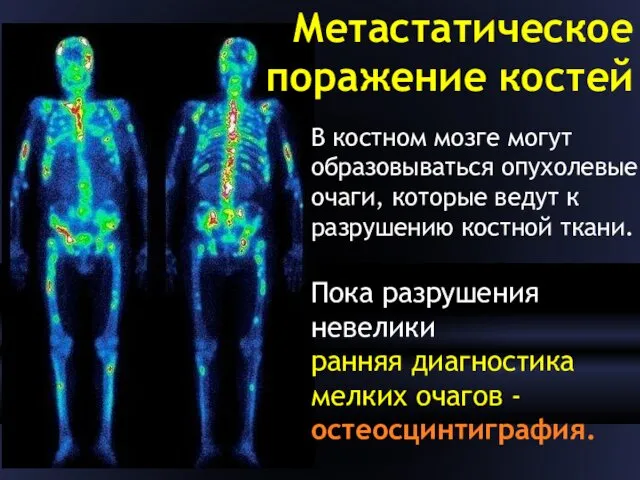 Метастатическое поражение костей В костном мозге могут образовываться опухолевые очаги,