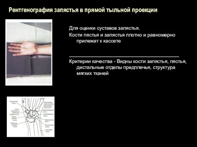 Рентгенография запястья в прямой тыльной проекции Для оценки суставов запястья.