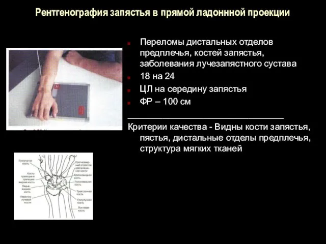 Рентгенография запястья в прямой ладоннной проекции Переломы дистальных отделов предплечья,