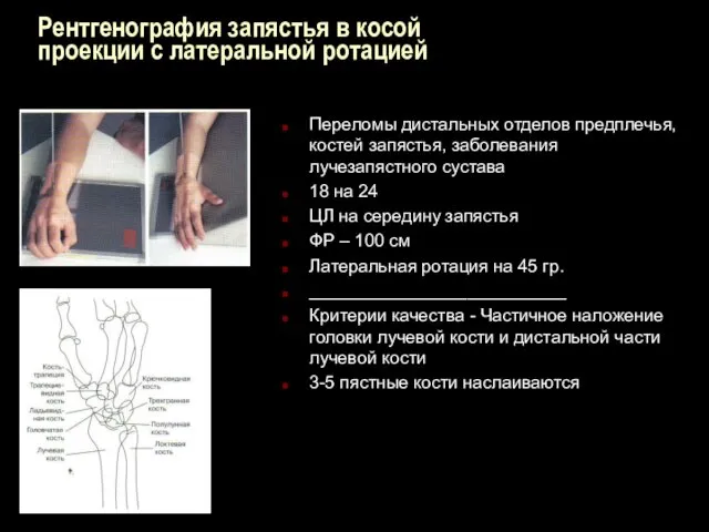 Рентгенография запястья в косой проекции с латеральной ротацией Переломы дистальных