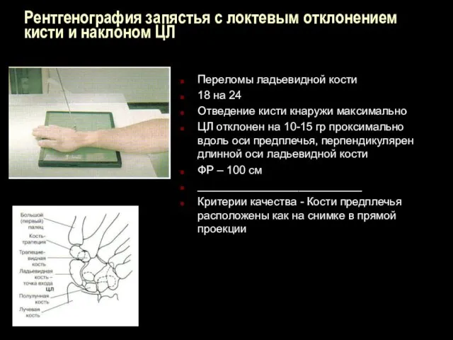 Рентгенография запястья с локтевым отклонением кисти и наклоном ЦЛ Переломы