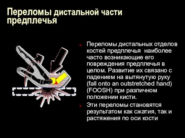 Переломы дистальной части предплечья Переломы дистальных отделов костей предплечья наиболее