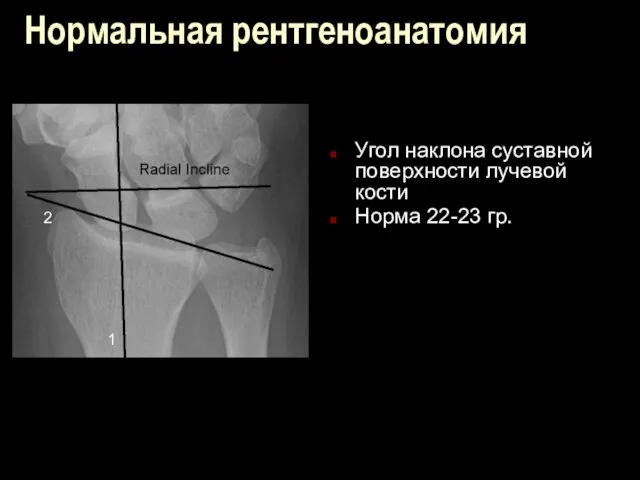 Нормальная рентгеноанатомия Угол наклона суставной поверхности лучевой кости Норма 22-23 гр. 1 2