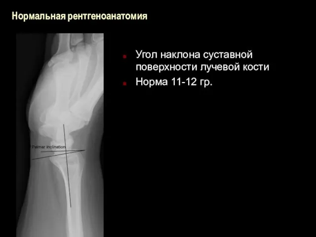 Нормальная рентгеноанатомия Угол наклона суставной поверхности лучевой кости Норма 11-12 гр.